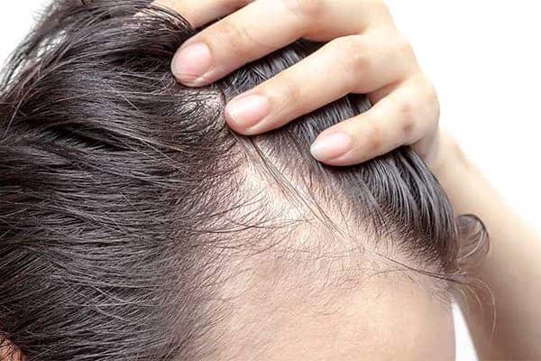 traitement effluvium telogene homme alopecie androgenetique grosse perte de cheveux clinique greffe de cheveux robotisee paris implants capillaires greffe de cheveux the clinic paris