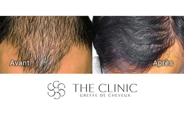 avant apres greffe de cheveux 10 mois apres clinique implants artas greffons greffe capillaires avant apres the clinic paris