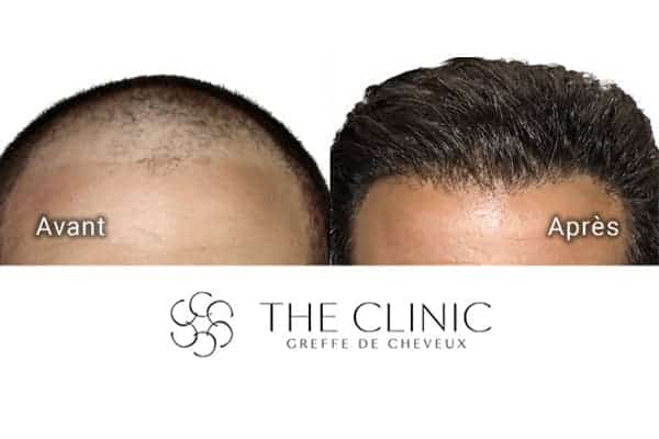 avant apres greffe de cheveux 10 mois apres clinique implants greffons artas greffe capillaires avant apres the clinic paris