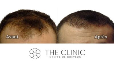 Tabac et greffe de cheveux : The Clinic fait le point