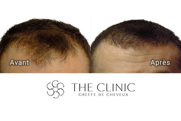 avant apres greffe de cheveux 14 mois apres clinique implants artas greffons greffe capillaires avant apres the clinic paris