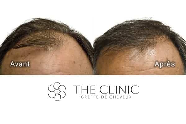 avant apres greffe de cheveux 9 mois apres clinique implants greffons greffe capillaires avant apres the clinic paris