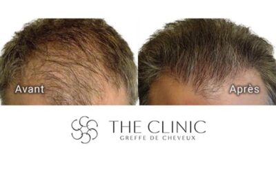 Greffe de cheveux : 7 raisons de sauter le pas