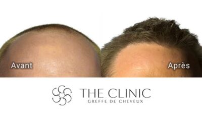 Greffe de cheveux : comment choisir la bonne clinique ?