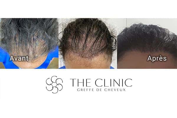 avant apres greffe de cheveux clinique implants artas greffons greffe capillaires avant apres the clinic paris m