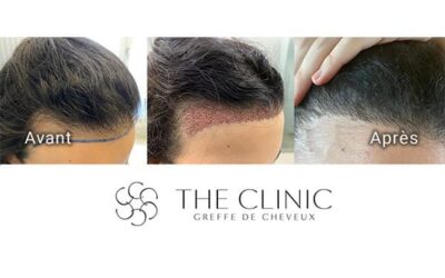Greffe de cheveux en France : c’est quoi le juste prix ?