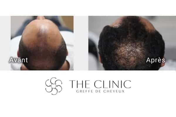 avant apres greffe de cheveux clinique implants greffons greffe capillaires avant apres the clinic paris a