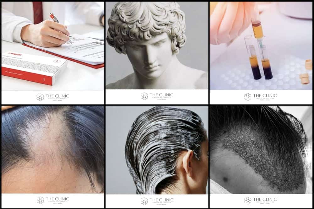 flux instagram the clinic paris greffes de cheveux implants capillaires lutte contre la perte de cheveux et la calvitie