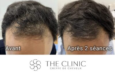 Chute de cheveux post-greffe : est-ce normal ? (shock loss)