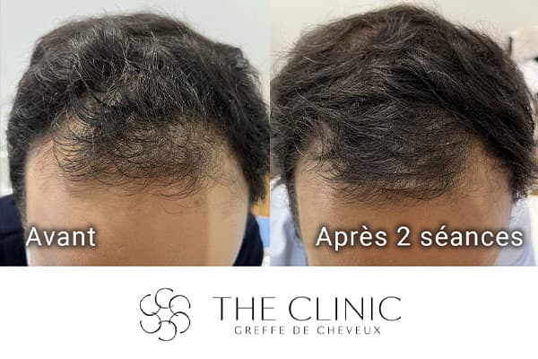 injection prp a cheveux maggelan avant apres clinique greffe de cheveux robotisee paris implants capillaires greffe de cheveux the clinic paris