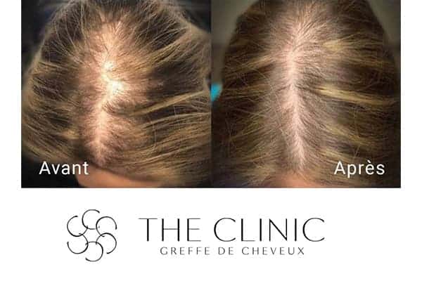 injection prp cheveux prp traitement capillaire perte de cheveux cause clinique implant capillaire greffe de cheveux the clinic paris