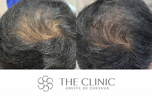 injection prp cheveux maggelan k avant apres clinique greffe de cheveux robotisee paris implants capillaires greffe de cheveux the clinic paris