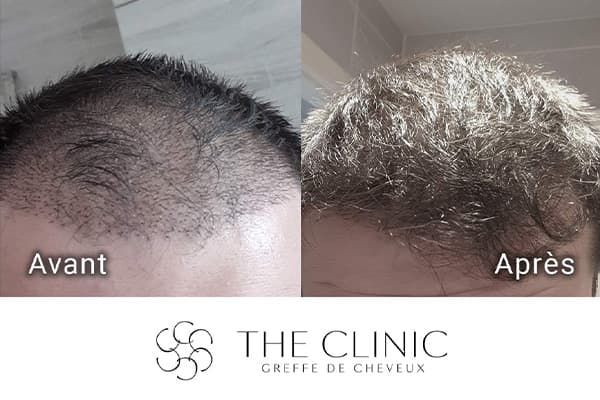 resultat greffe de cheveux implant capillaire greffons resultat the clinic paris a