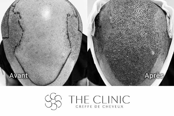 resultat greffe de cheveux implant capillaire greffons resultat the clinic paris d