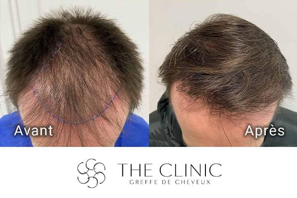 resultat greffe de cheveux implant capillaire greffons resultat the clinic paris j