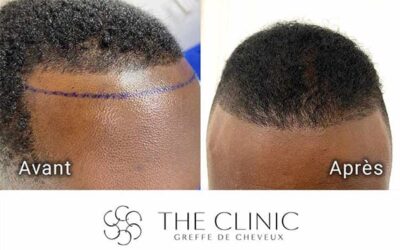 Abaissement de la ligne frontale de l’homme (ou réduction du front)