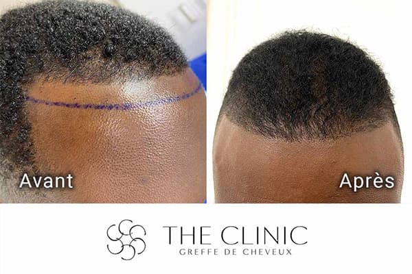 resultat greffe de cheveux implant capillaire greffons resultat the clinic paris m