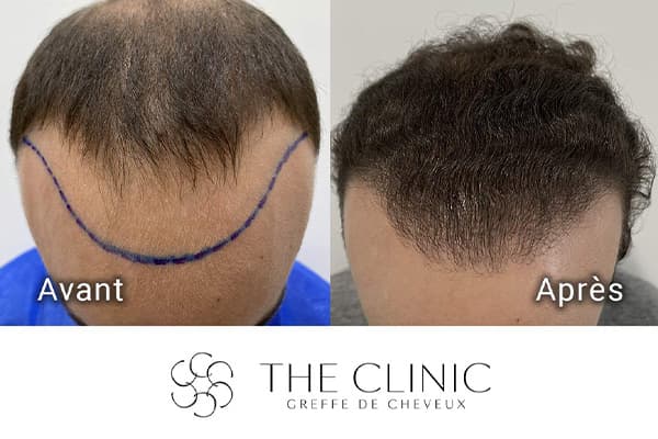 resultat greffe de cheveux implant capillaire greffons resultat the clinic paris r