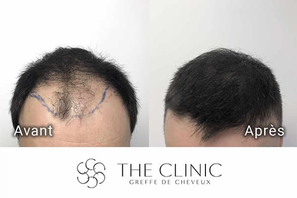 resultat greffe de cheveux implant capillaire greffons resultat the clinic paris w