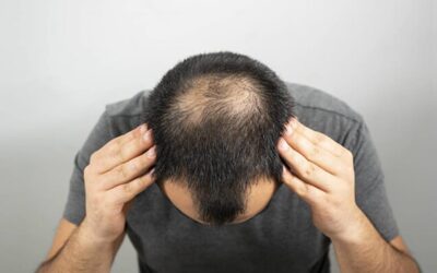 Discrimination capillaire et Chute de Cheveux