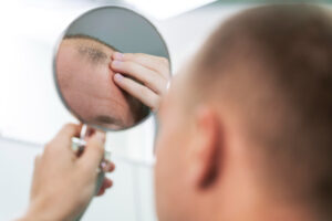 traitement medicament pelade alopecie areata paris clinique chute de cheveux the clinic