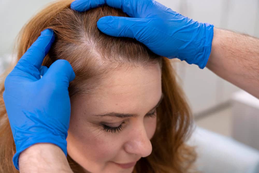 therapie exosomes chute de cheveux alopecie calvitie efficacite protocole quand quel cas the clinic paris traitement capillaire