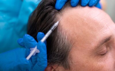 La Thérapie par Exosomes pour la Chute des Cheveux : Vraiment Miraculeuse ?