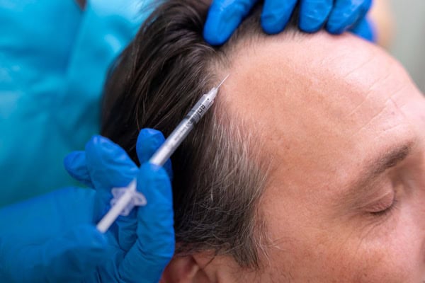 therapie exosomes chute de cheveux alopecie calvitie efficacite protocole quand quel cas the clinic paris traitement capillaire