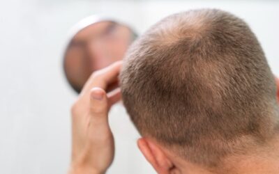 Minoxidil en comprimé : une alternative efficace contre la chute de cheveux