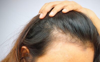 Alopécie de traction : que faire à la vue des premiers symptômes ?