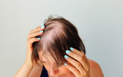 L’alopécie c’est quoi ? Définition, causes et traitement
