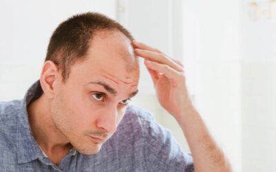 Perte de cheveux chez l’homme, quelles sont les causes principales ?